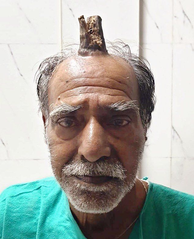 Индийцу удалили десятисантиметровый "дьявольский" рог