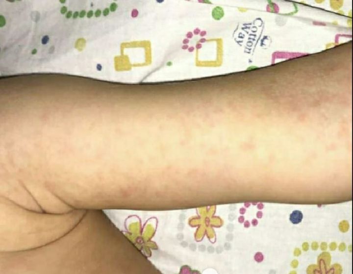 Врач Татарстана: коронавирус у детей может проявляться в виде сыпи на коже (ФОТО)