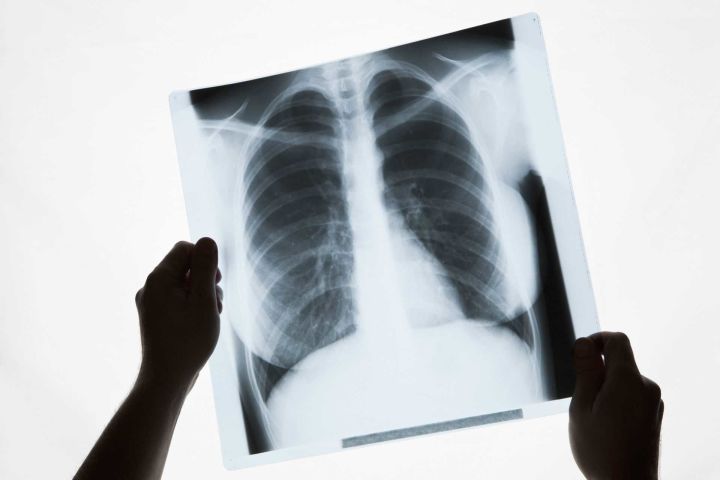 Благодаря флюорографическому исследованию в Бавлах удалось выявить больных туберкулёзом