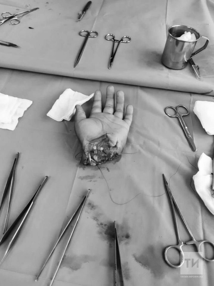 Татарстанские врачи пришили подростку отрубленную топором руку