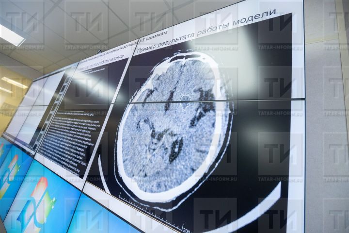 Признаки развития болезни Альцгеймера